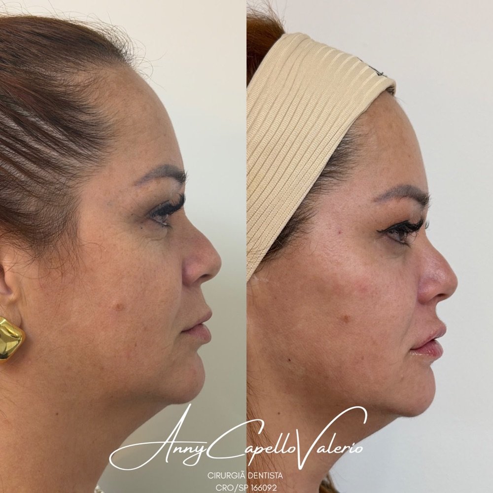 Resultado de protocolo Full Face